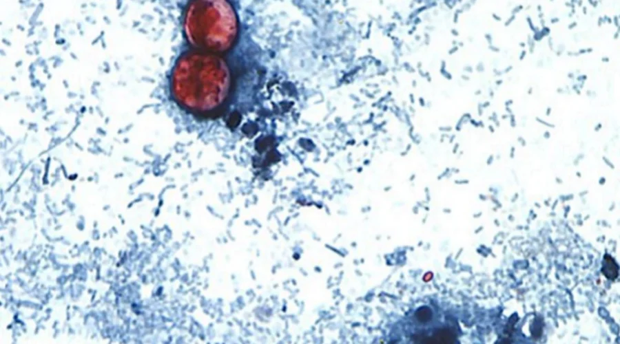 cyclosporiasis-01-ht-jt-260702_1783003305051_hpMain_16x9-1