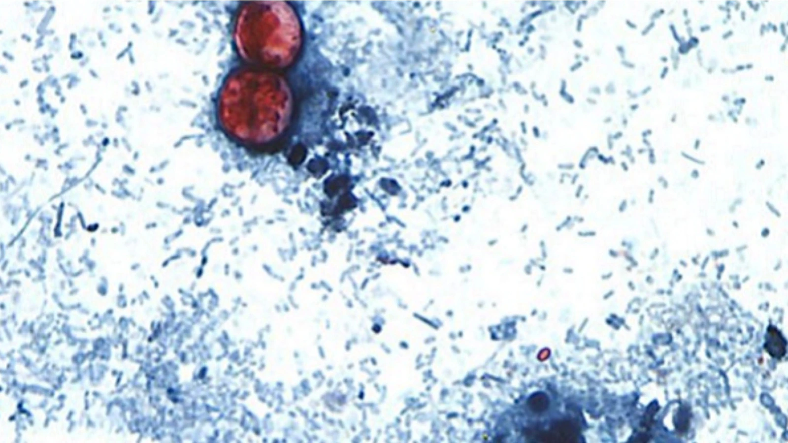 cyclosporiasis-01-ht-jt-260702_1783003305051_hpMain_16x9-1