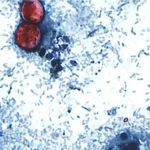 cyclosporiasis-01-ht-jt-260702_1783003305051_hpMain_16x9