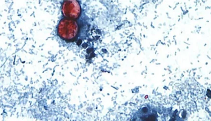 cyclosporiasis-01-ht-jt-260702_1783003305051_hpMain_16x9