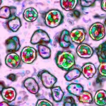 measles-1-gty-er-260120_1768925917623_hpMain_3_16x9